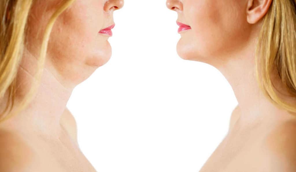 Double Chin treatment Diss before and after results