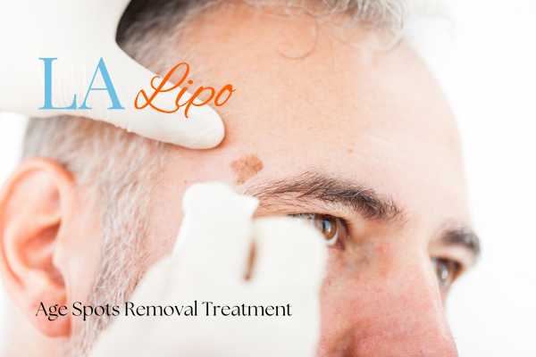 What Are the Most Effective Treatments for Age Spots Diss?