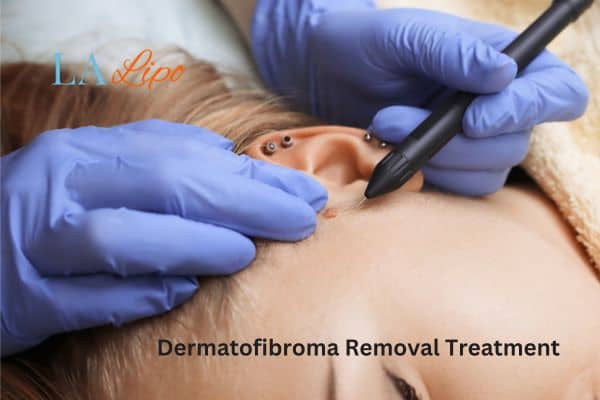 Dermatofibroma Removal Treatment Diss