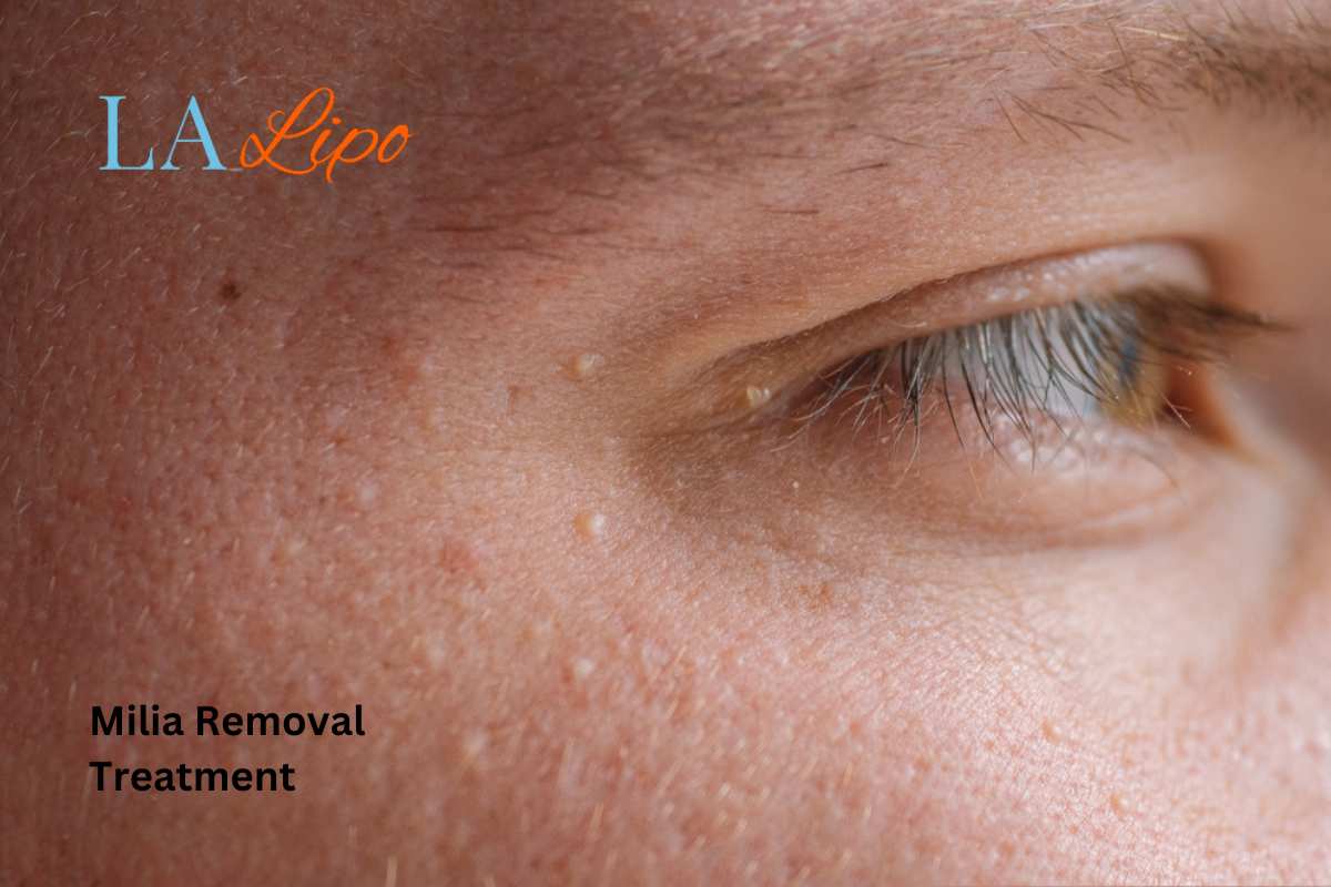 Cryopen Milia Removal: Is It the Easiest and Safest Option Diss?