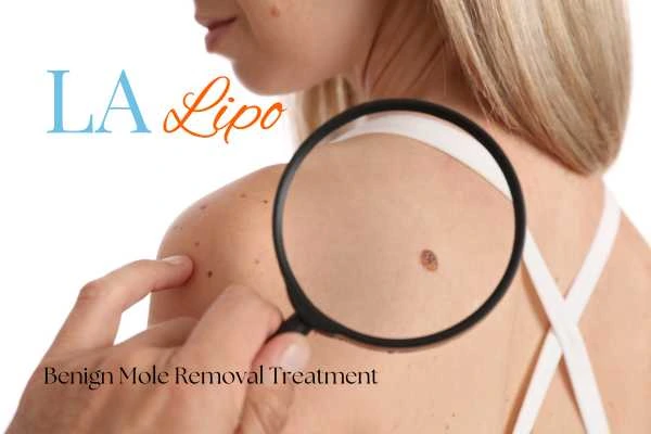 Why getting moles removed Diss can boost your confidence!