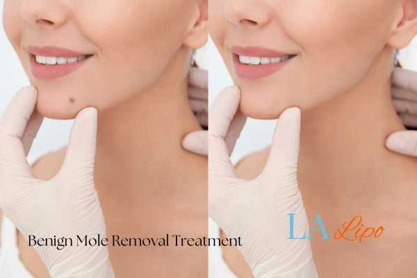 woman's before and after mole removal Diss results
