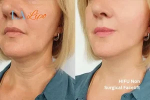 hi-fu for wrinkles Diss before and after results