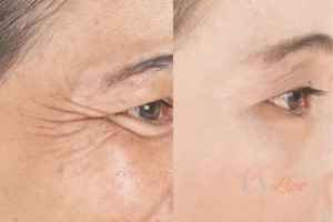 Before and after results of woman - HI-fu wrinkles reduction treatment Diss