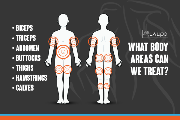 Graphic to show areas you can have LA-EMS Body Sculpting Diss treatment.