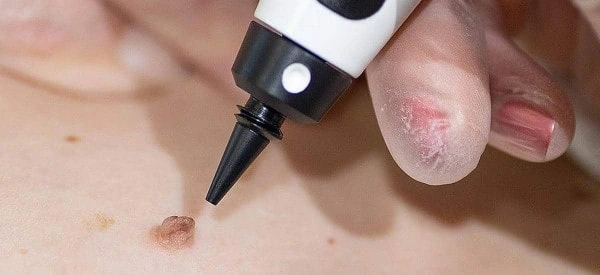 skin tag removal using cryopen Diss