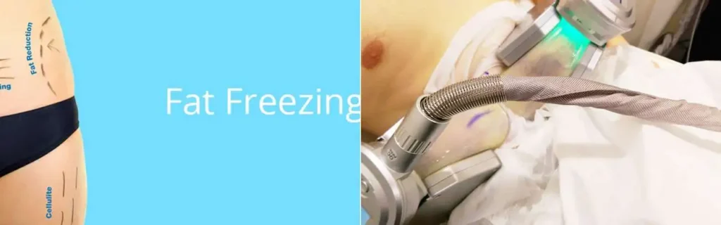 Fat freezing Diss on multiple areas of the body