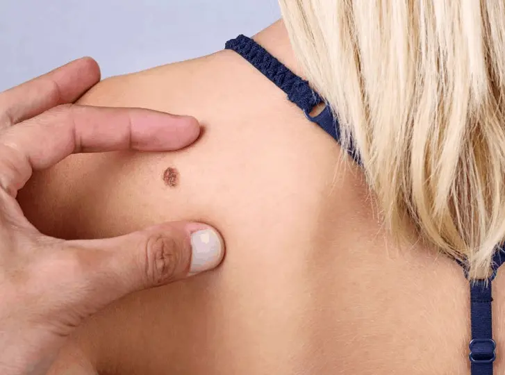 woman having mole removal Diss consultation before treatment.