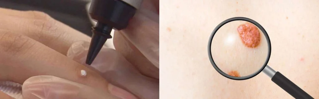 Person getting moles removed with cryopen Diss