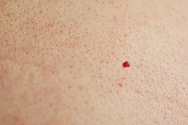 close up of a cherry angioma Diss