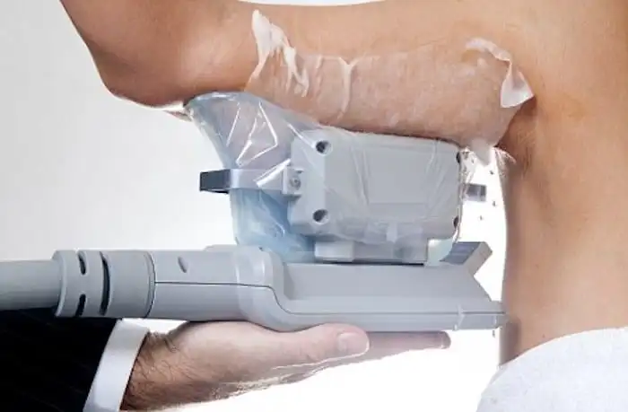 Picture of fat freezing Diss on the upper arms.