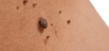 image of a skin tag Diss