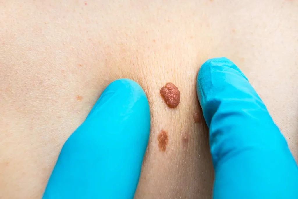 Consultant examining a skin tag Diss