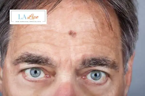 Solar Lentigo Removal Diss image of man with mark on his forehead