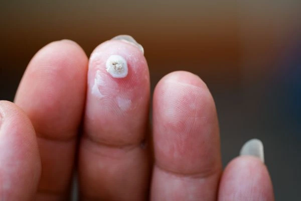 wart on person finger - cryotherapy to treat from LA LIPO Diss