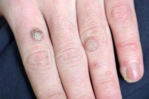 photo of warts on person hand - see wart removal Diss from LA LIPO