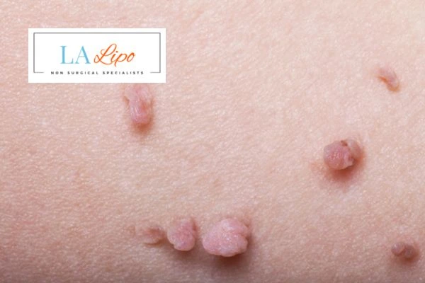 Does cryopen skin tag removal Diss hurt? Find out now call our team today!