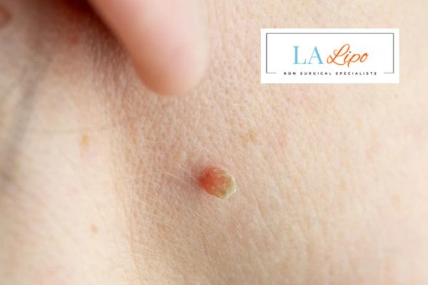 Book skin tag removal Diss today speak to our team now!