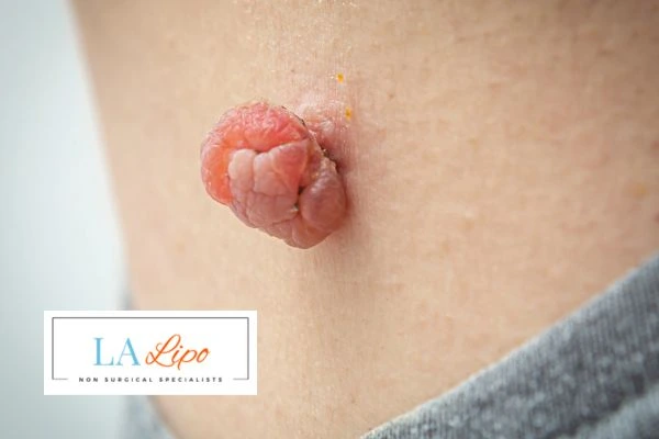 Interested in skin tag removal Diss? Concerned about the pain? Find out more today!