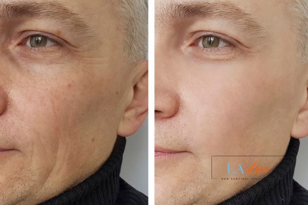 See the amazing results of Morpheus8 Treatment Diss!