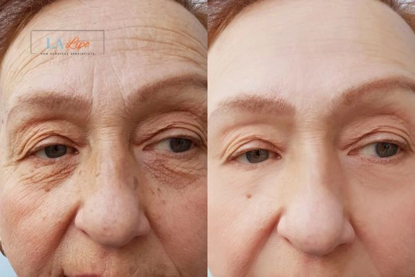 The powerful benefits of Morpheus8 Treatment Diss - Call Our team today!