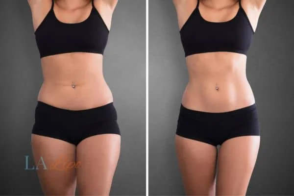 before and after results of non-surgical treatment to help a woman's body image and mental health Diss