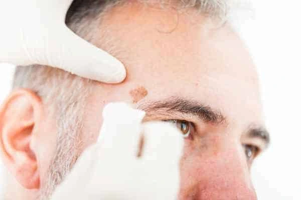 Age spots and elderly people Diss what is the link?