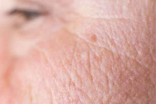 close up picture of a woman's face showing an age spot Diss