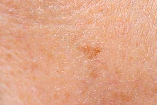 close up picture of age spots Diss