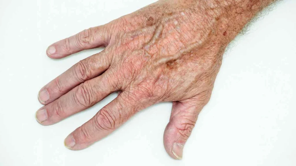 Male hand showing age spot Diss