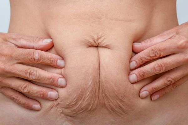 Image of a woman's stomach with loose skin - example of skin tightening Diss options