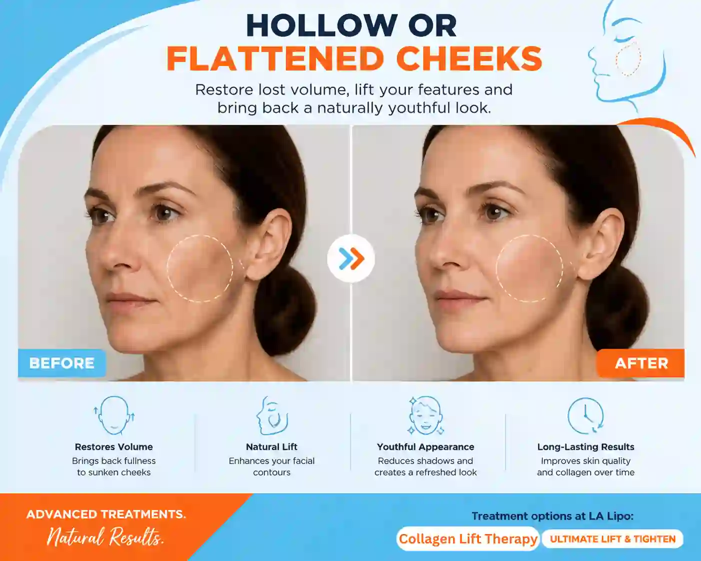 Sign #4: Hollow or Flattened Cheeks Diss